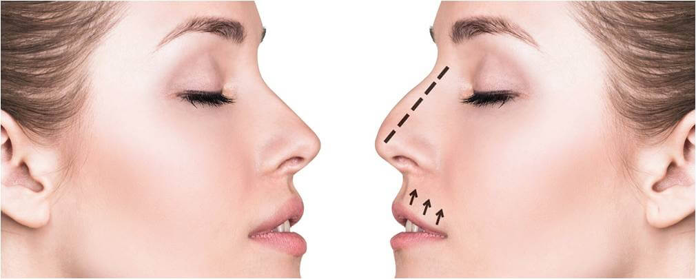 rinoplastia cirurgia ao nariz