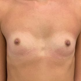 mamoplastia de aumento caso antes