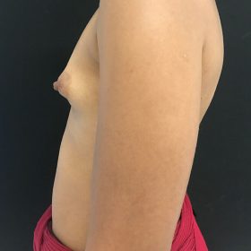 mamoplastia de aumento lateral caso antes