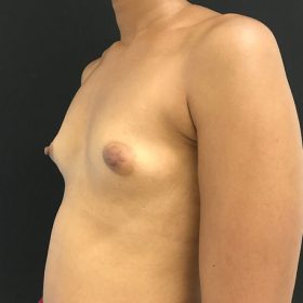 mamoplastia de aumento 45 graus caso antes