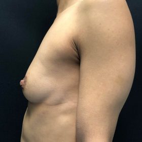mamoplastia caso antes lateral