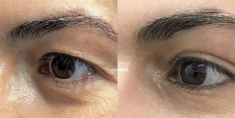 Casos Antes e Depois de Blefaroplastia - MyMoment - Cirurgia plástica