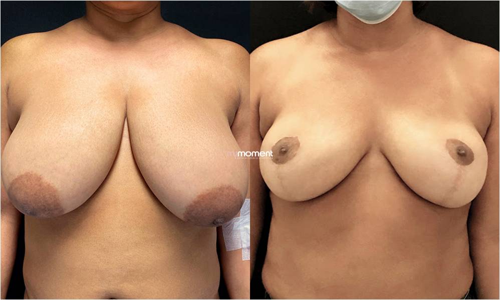 mamoplastia de redução