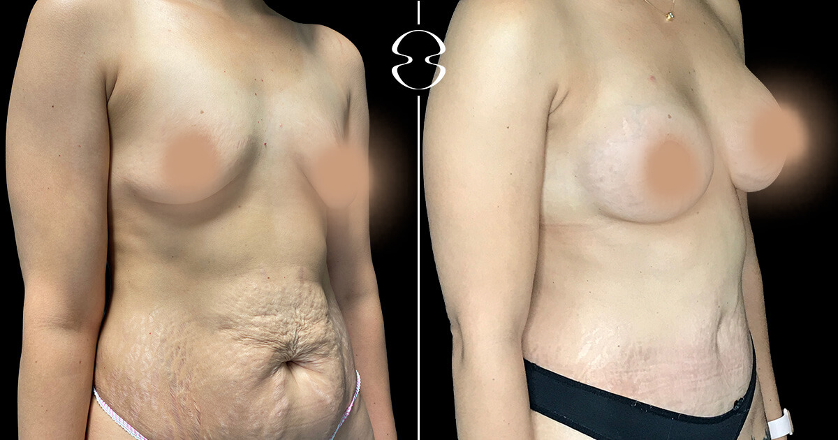 Mommy Makeover caso antes e depois