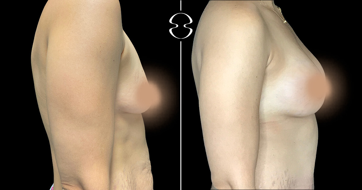 Mommy Makeover caso antes e depois