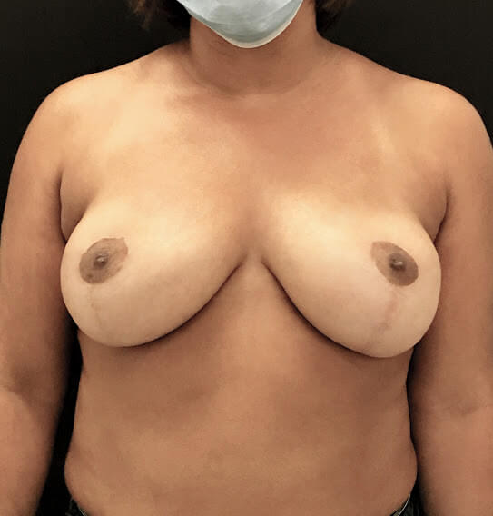 mamoplastia de redução caso depois frente