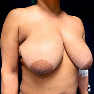 mamoplastia de redução caso antes lateral