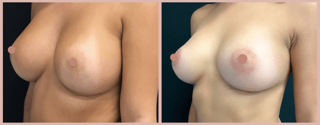 implante mamários