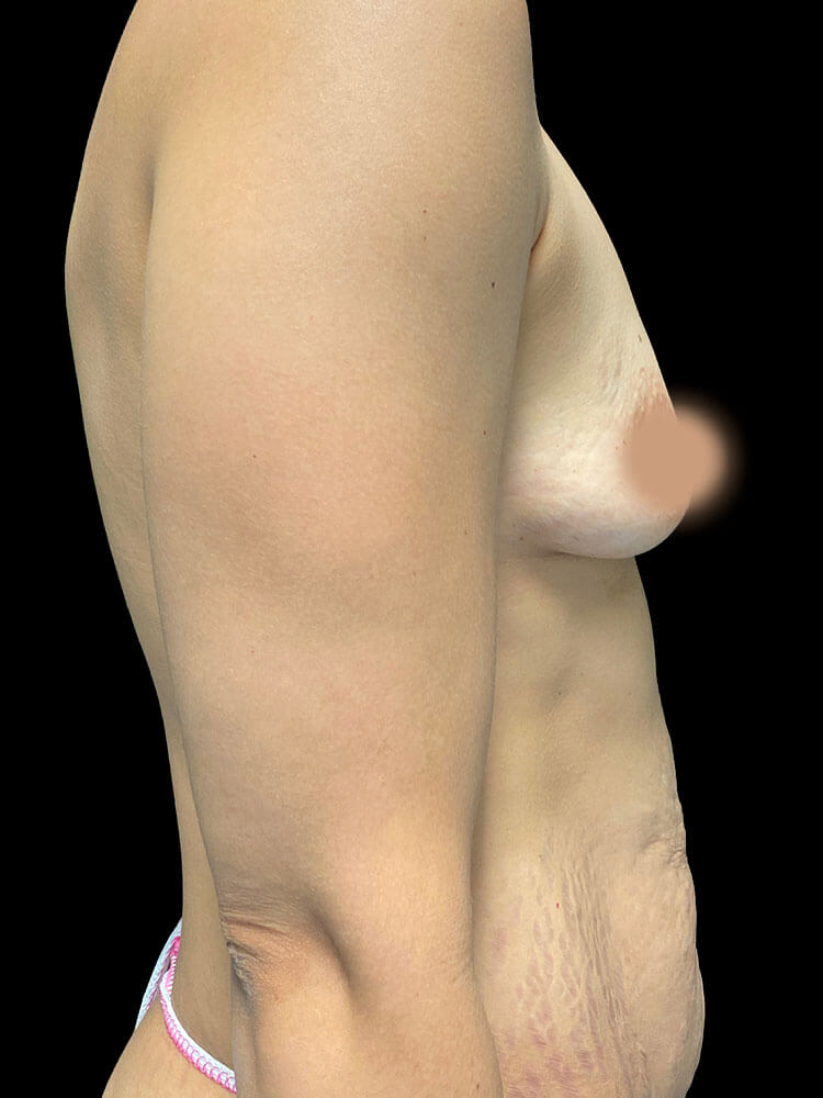 Mommy Makeover caso antes e depois