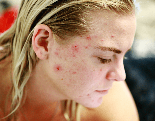 acne; senhora com acne no rosto