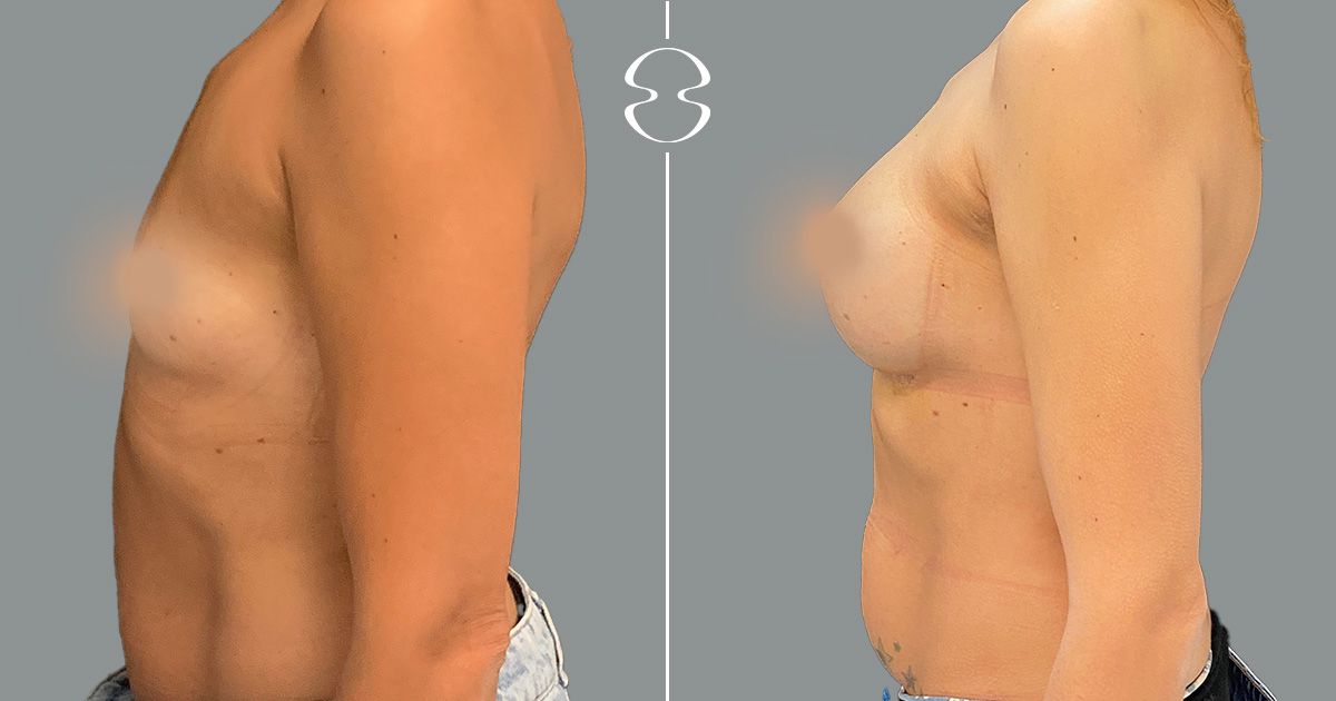 caso antes e depois mamoplastia de aumento 17440