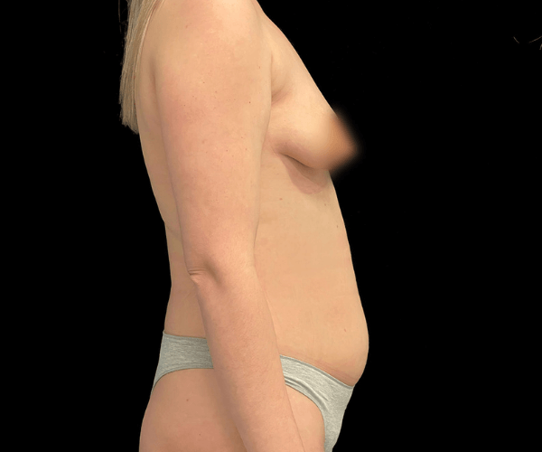 mastopexia e mama tuberosa foto lateral antes