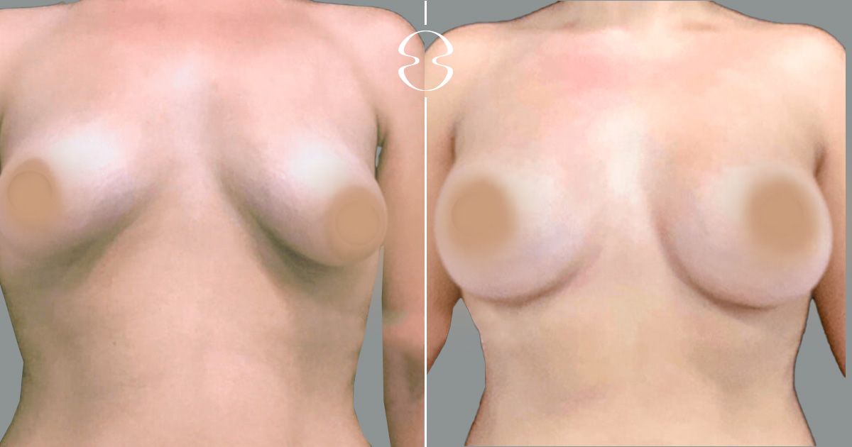 correção mama tuberosa antes e depois