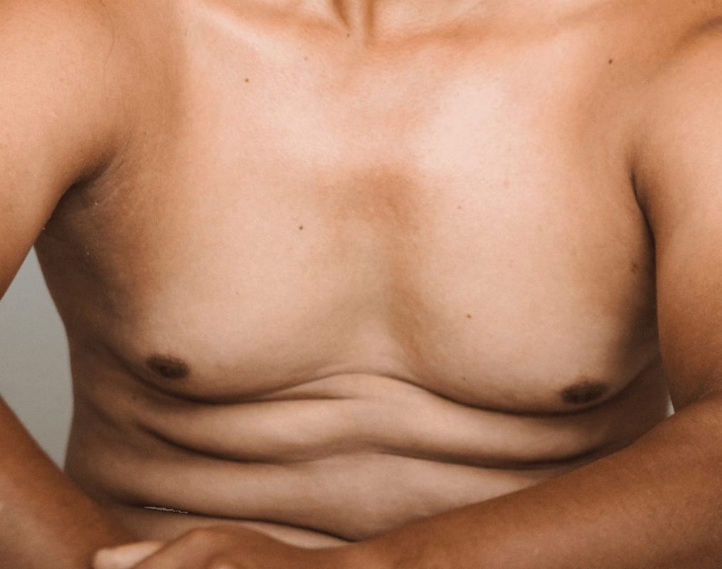 Ginecomastia: homens com mamas grandes