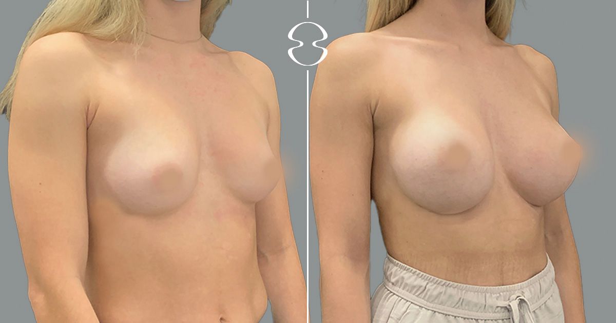mamoplastia de aumento caso antes e depois 17725
