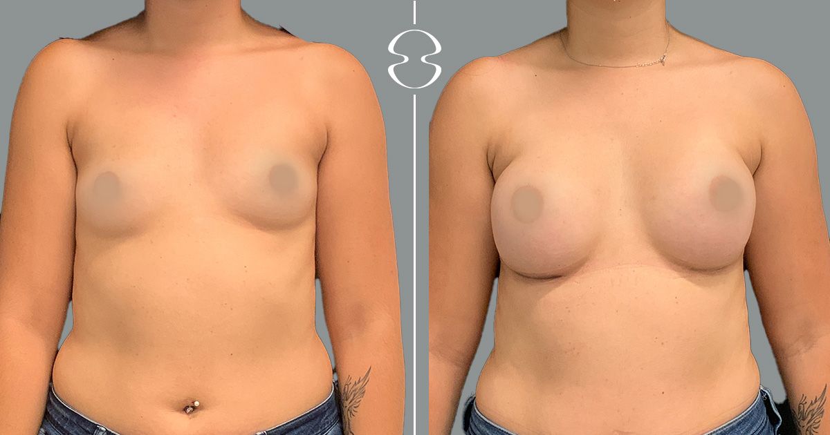 mamoplastia de aumento caso antes e depois 18890