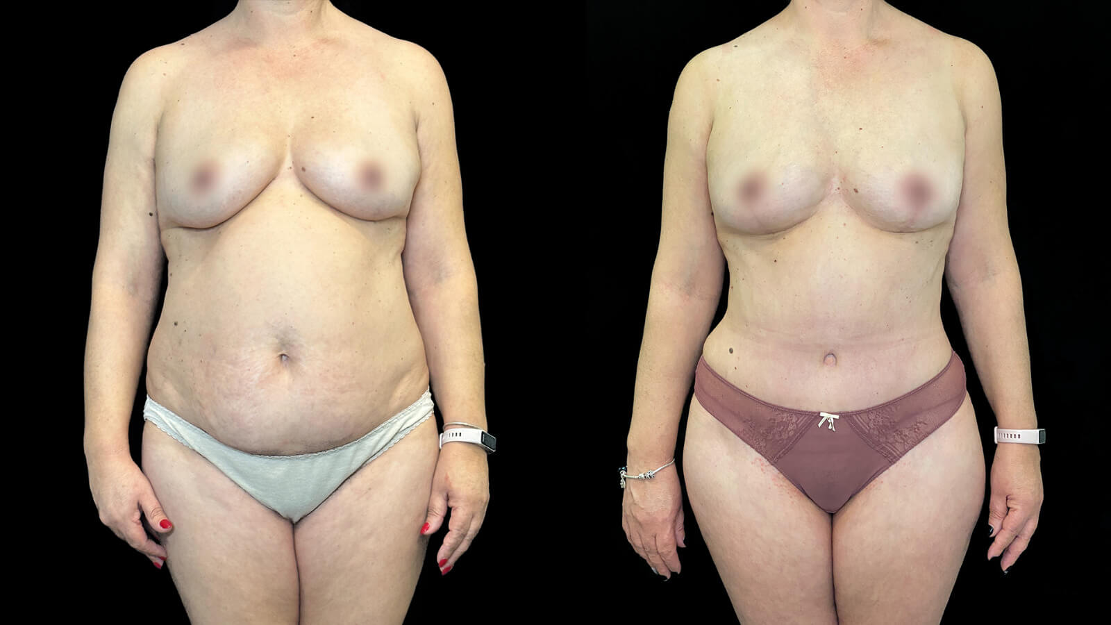 Antes e Depois Mommy Makeover