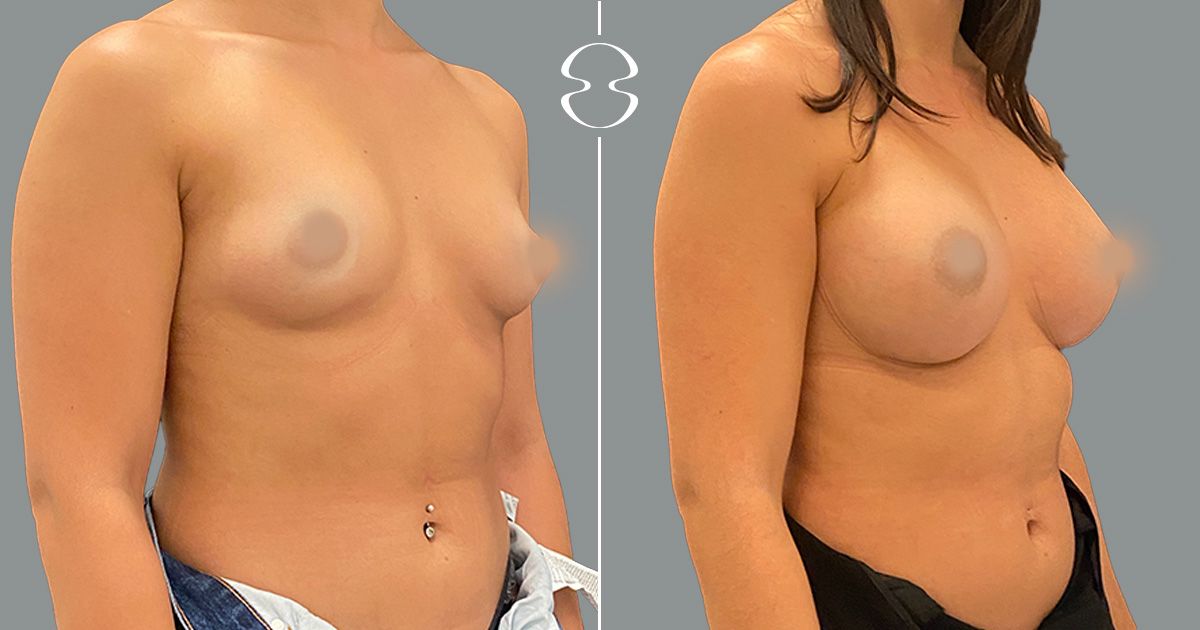 mamoplastia de aumento antes e depois