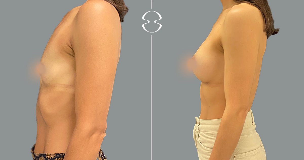 mamoplastia de aumento caso antes e de depois 18902