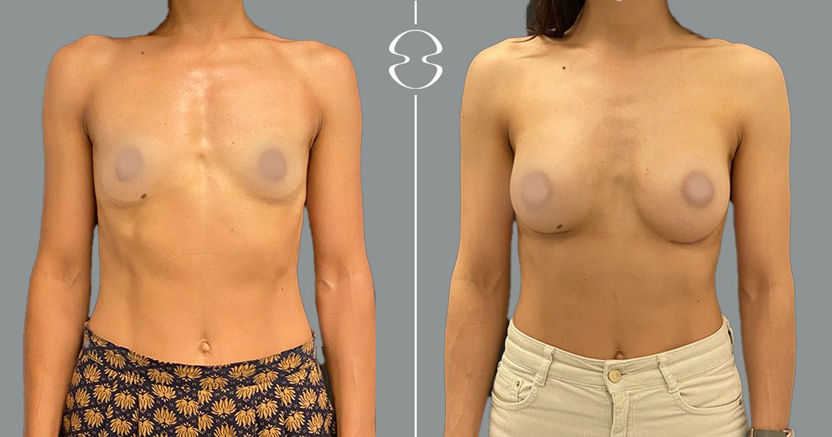 mamoplastia de aumento caso antes e de depois 18902