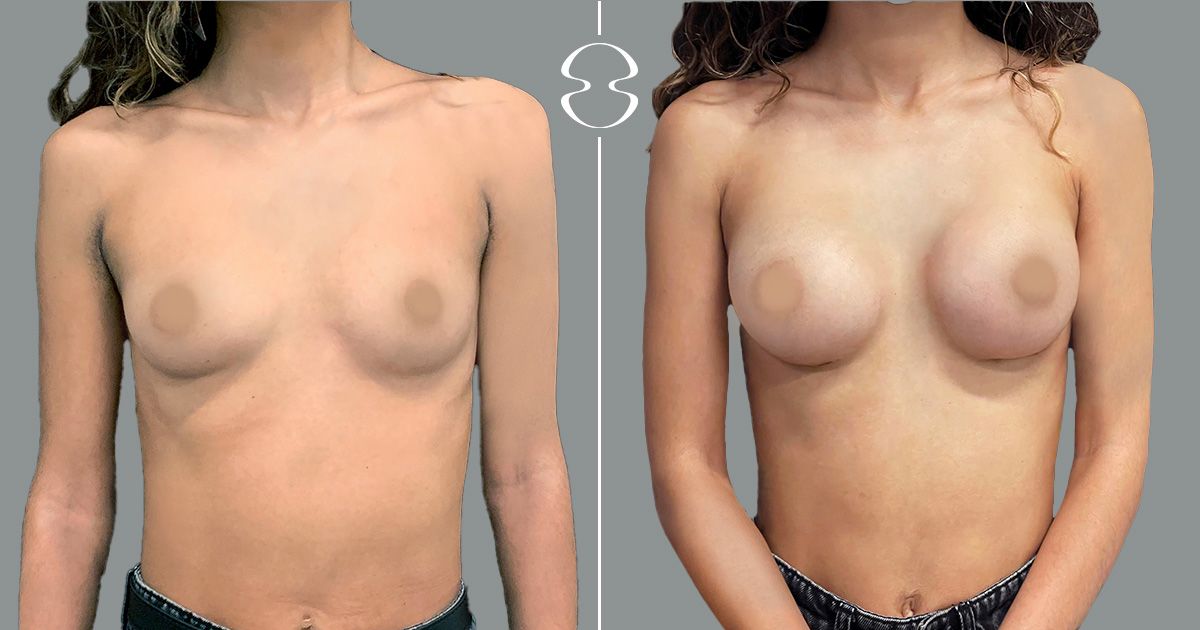 mamoplastia de aumento caso antes e de depois 19861