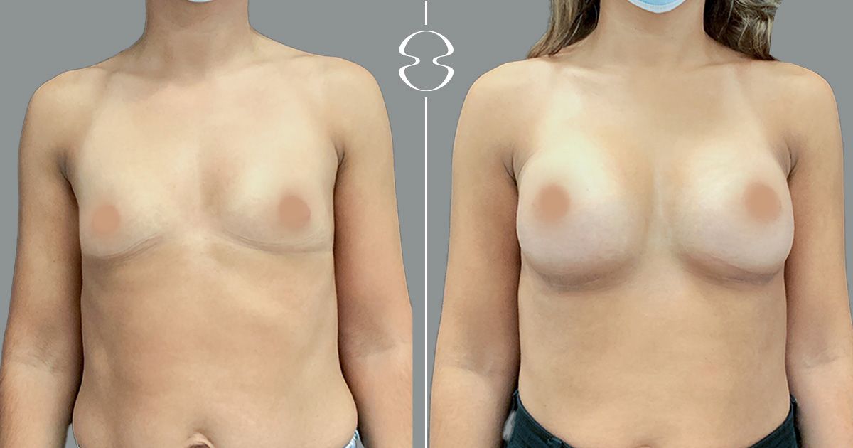 mamoplastia de aumento caso antes e depois 19465