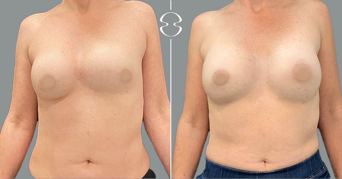 mamoplastia de aumento caso antes e depois 20187