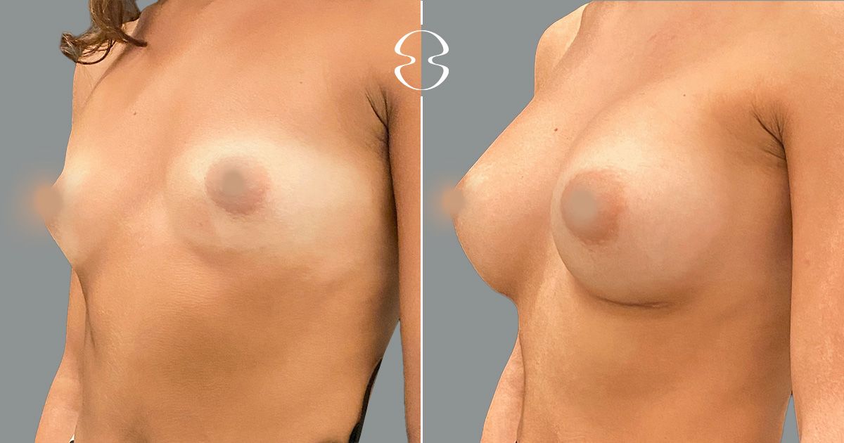 mamoplastia de aumento fotos antes e depois