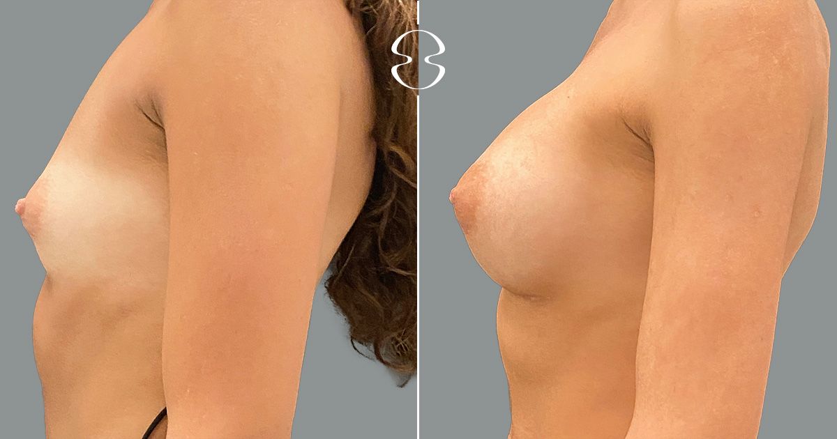 mamoplastia de aumento fotos antes e depois