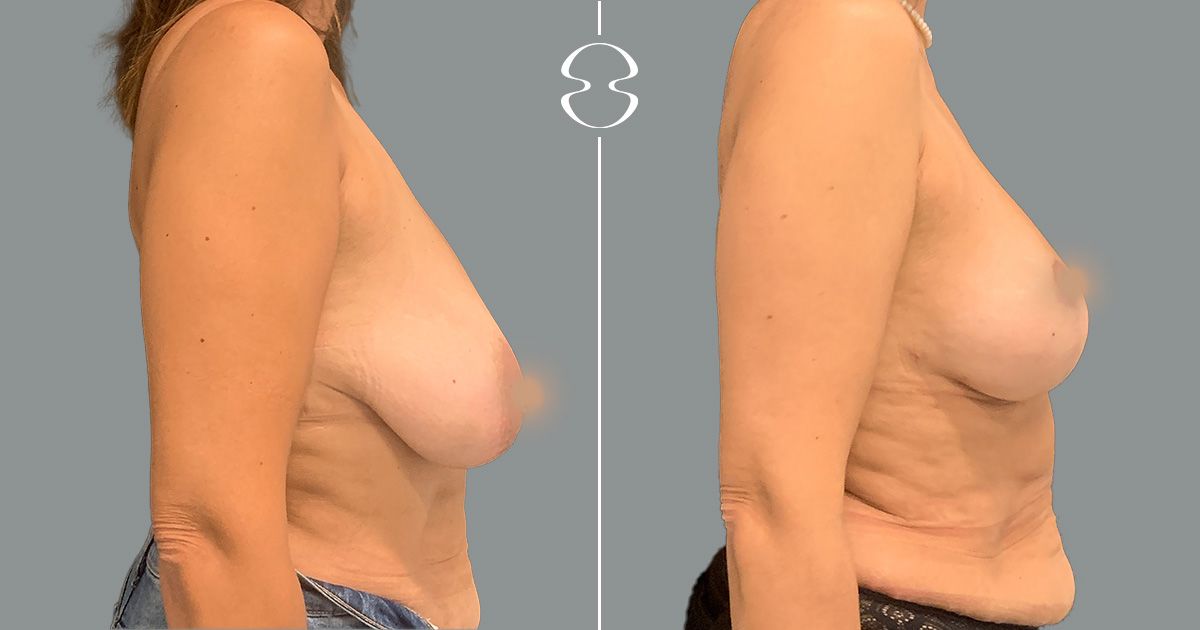 mamoplastia de redução antes e depois