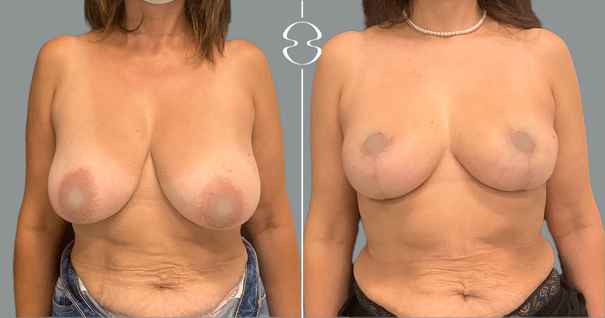 mamoplastia de redução antes e depois