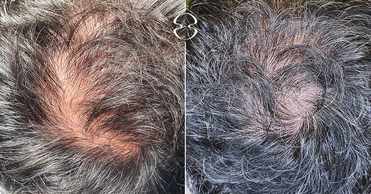 Tratamento da Alopecia Caso Antes e Depois 15782