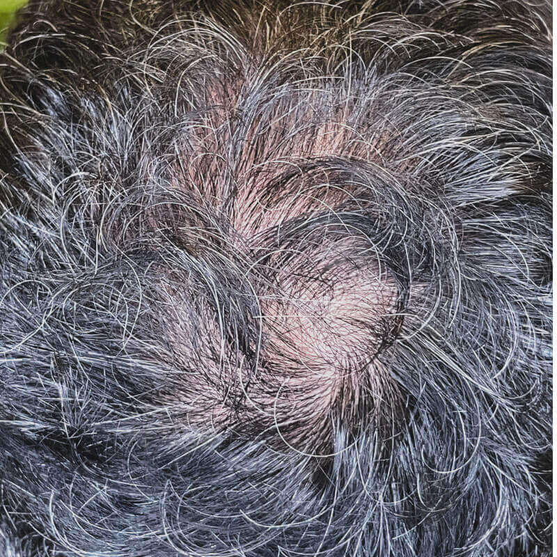 caso 15782 alopecia mymoment 2