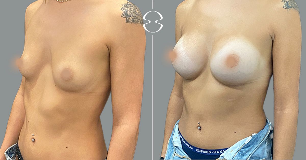 mamoplastia de aumento antes e depois