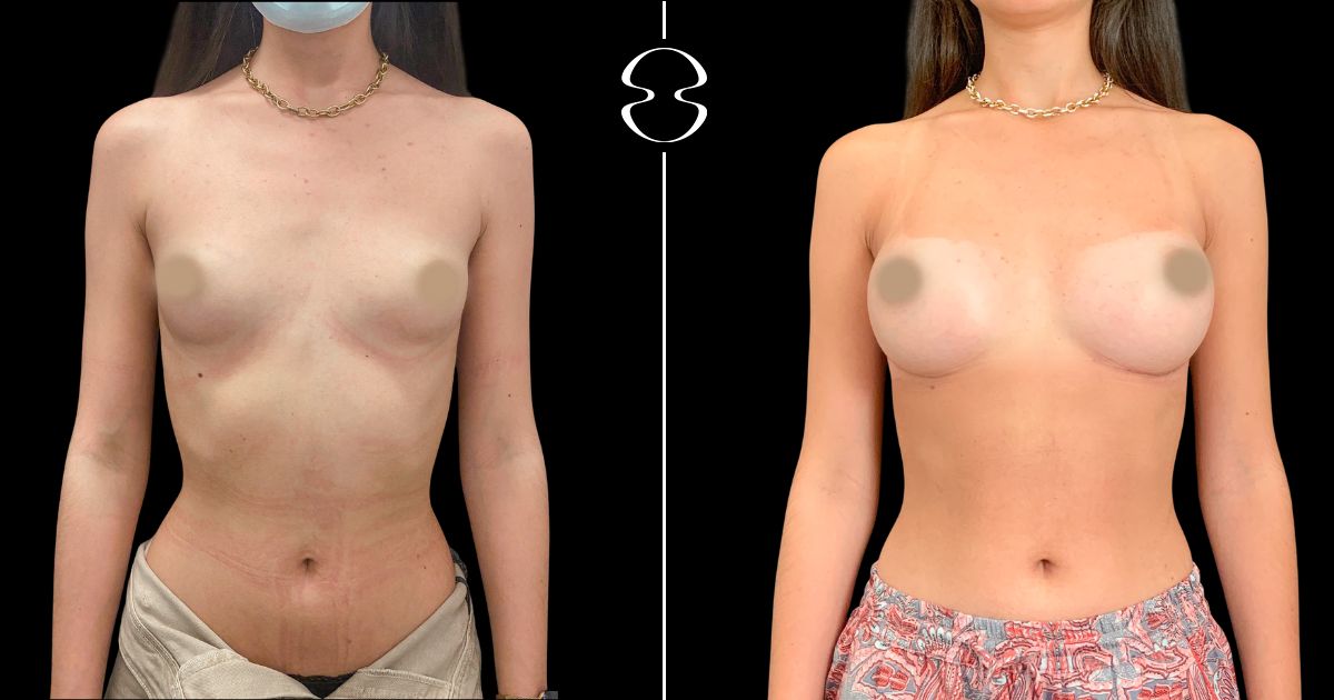 Mamoplastia de Aumento antes e depois