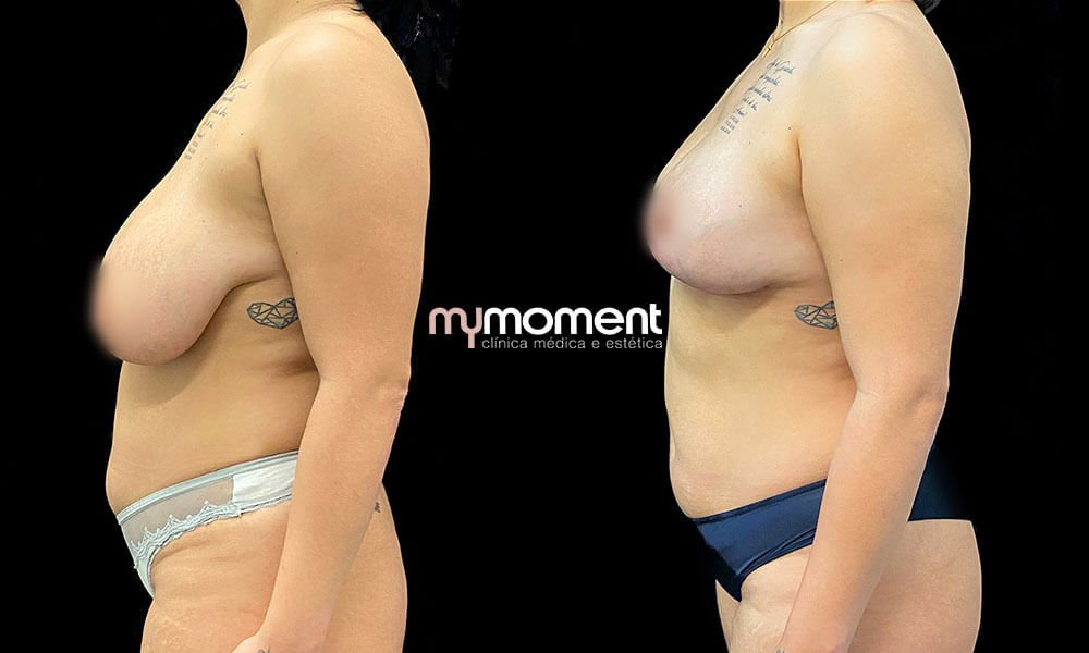 Antes e Depois Vanessa - Mamoplastia de Redução e redução de gordura abdominal localizada