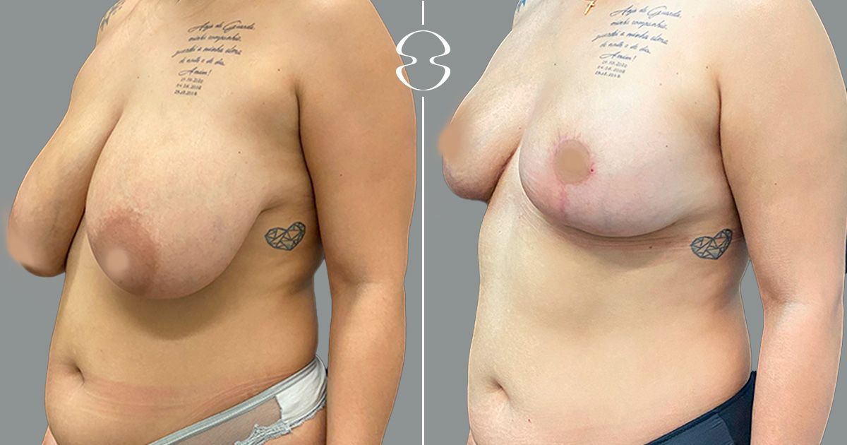 redução mamária antes e depois