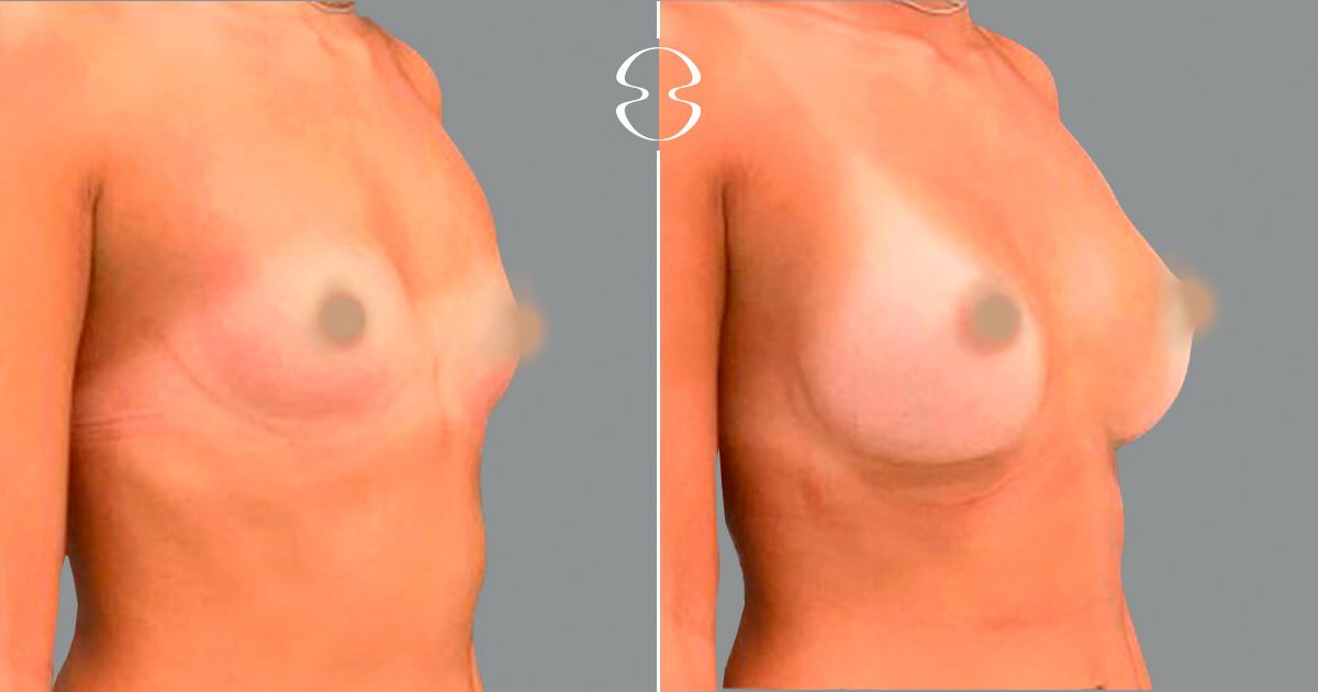 Mamoplastia de Aumento caso antes e depois