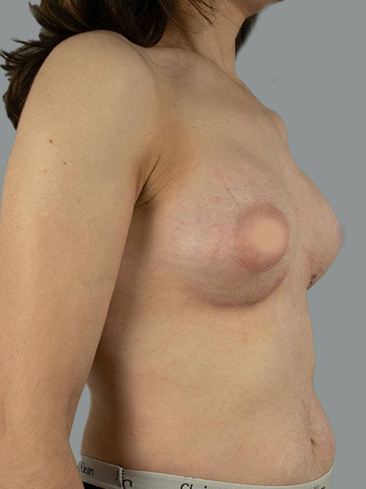 antes e depois mamoplastia de aumento rute sousa