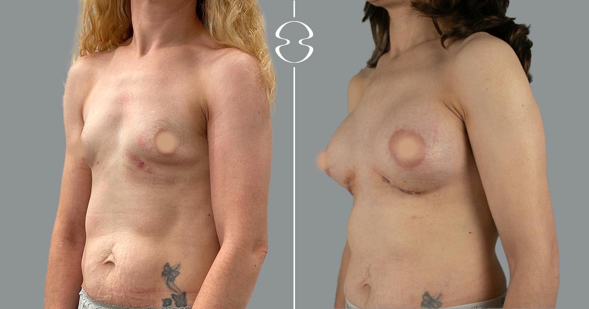 antes e depois mamoplastia de aumento rute sousa