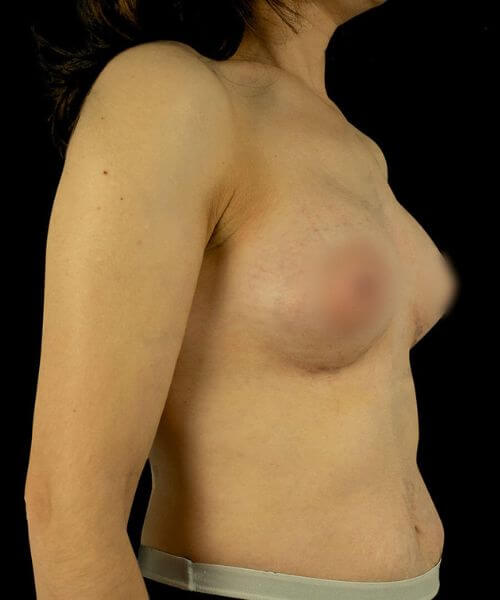 mamoplastia de aumento rute sousa foto depois