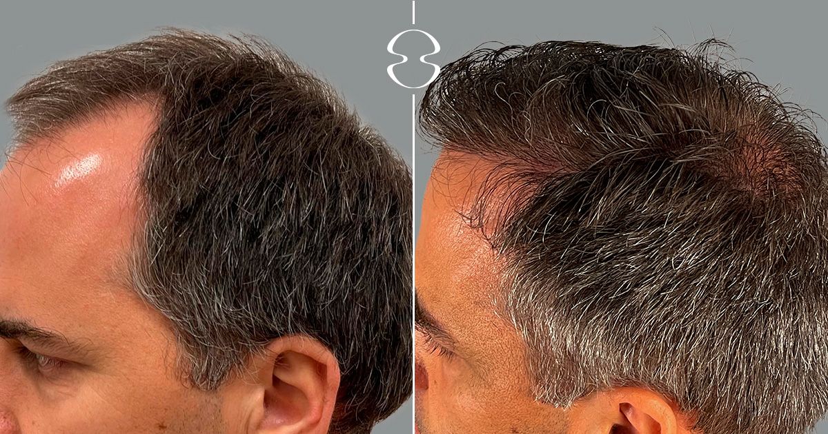 Tratamento da Alopecia Caso Antes e Depois