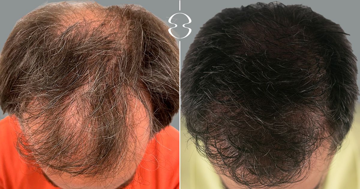 Tratamento da Alopecia Caso Antes e Depois