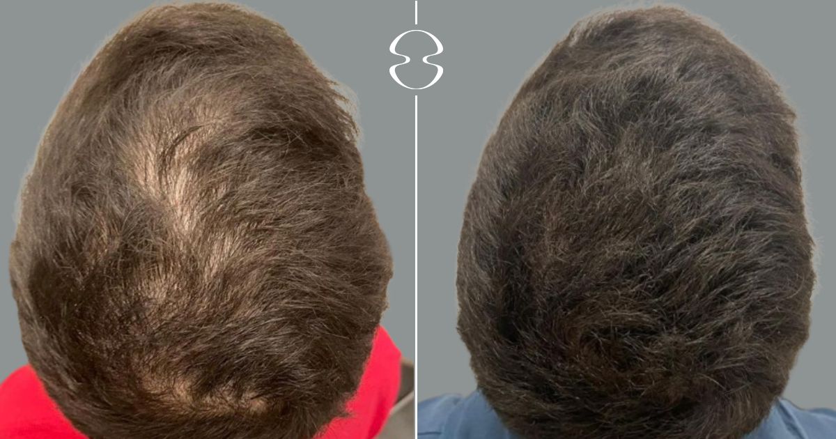 tratamento da alopecia caso antes e depois 19555