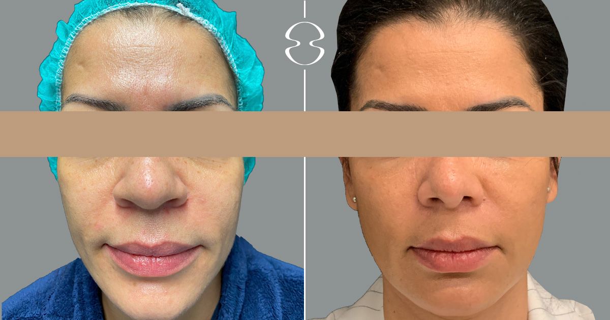 antes e depois de rinoplastia