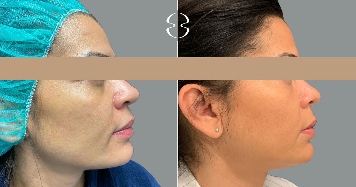 antes e depois de rinoplastia