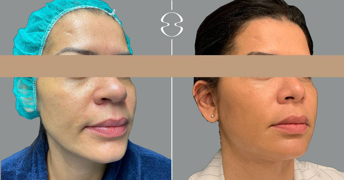 antes e depois de rinoplastia