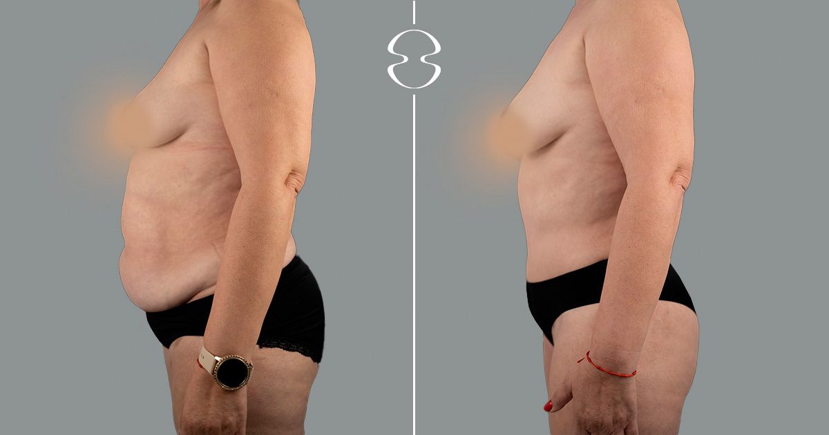 antes e depois lipoabdominoplastia
