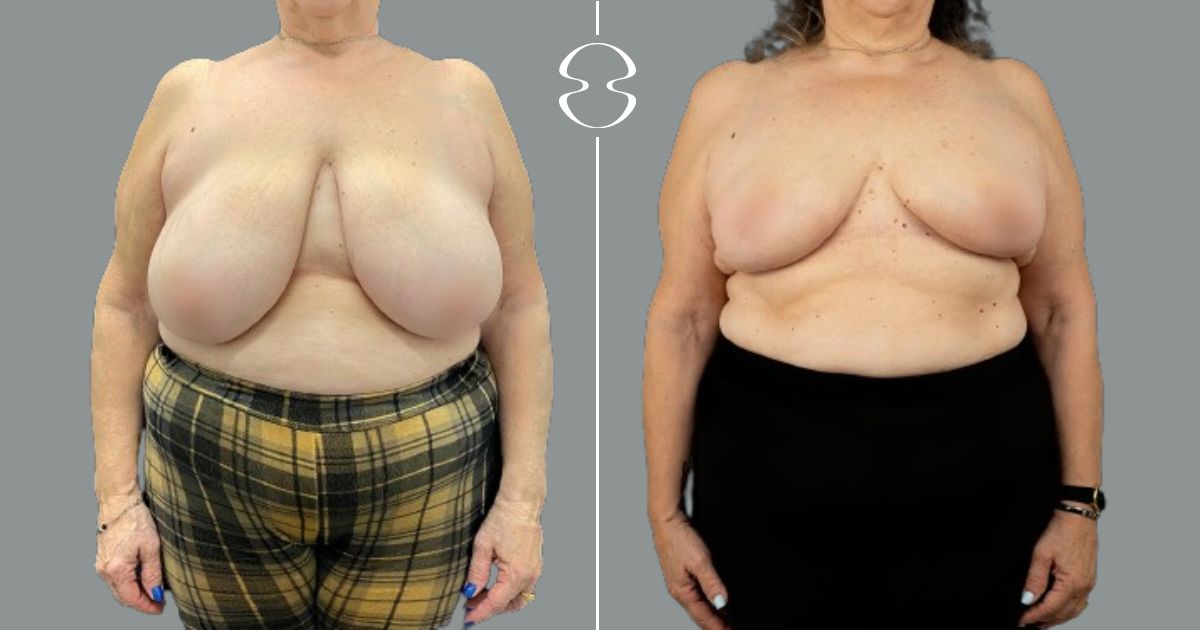 caso antes e depois mamoplastia de redução