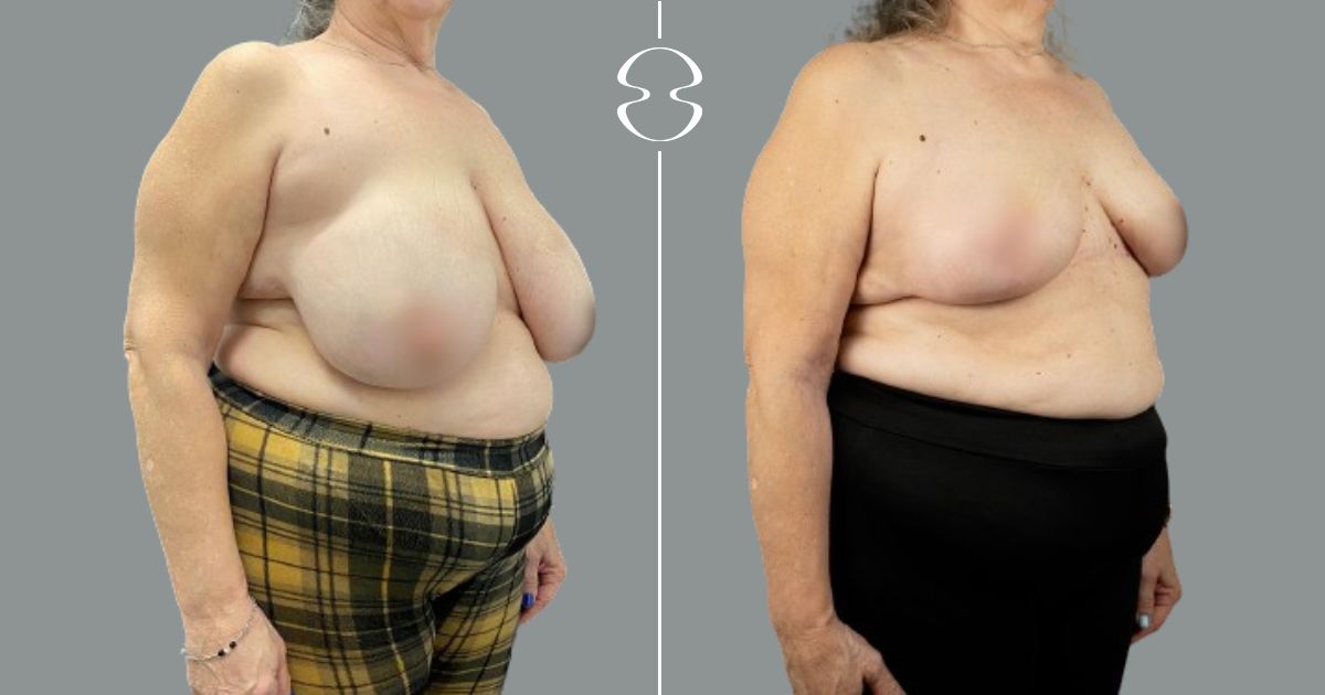 caso antes e depois mamoplastia de redução